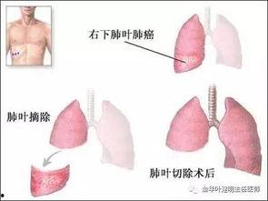 肺叶切除的明星